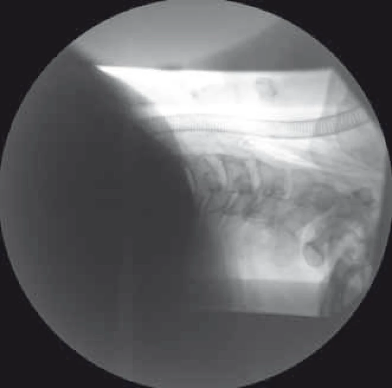 Peroperační RTG po snesení předních osteofytů (kazuistika 1).
Fig. 4. Intraoperative X-ray after the ablation of front osteophytes (a case report 1).