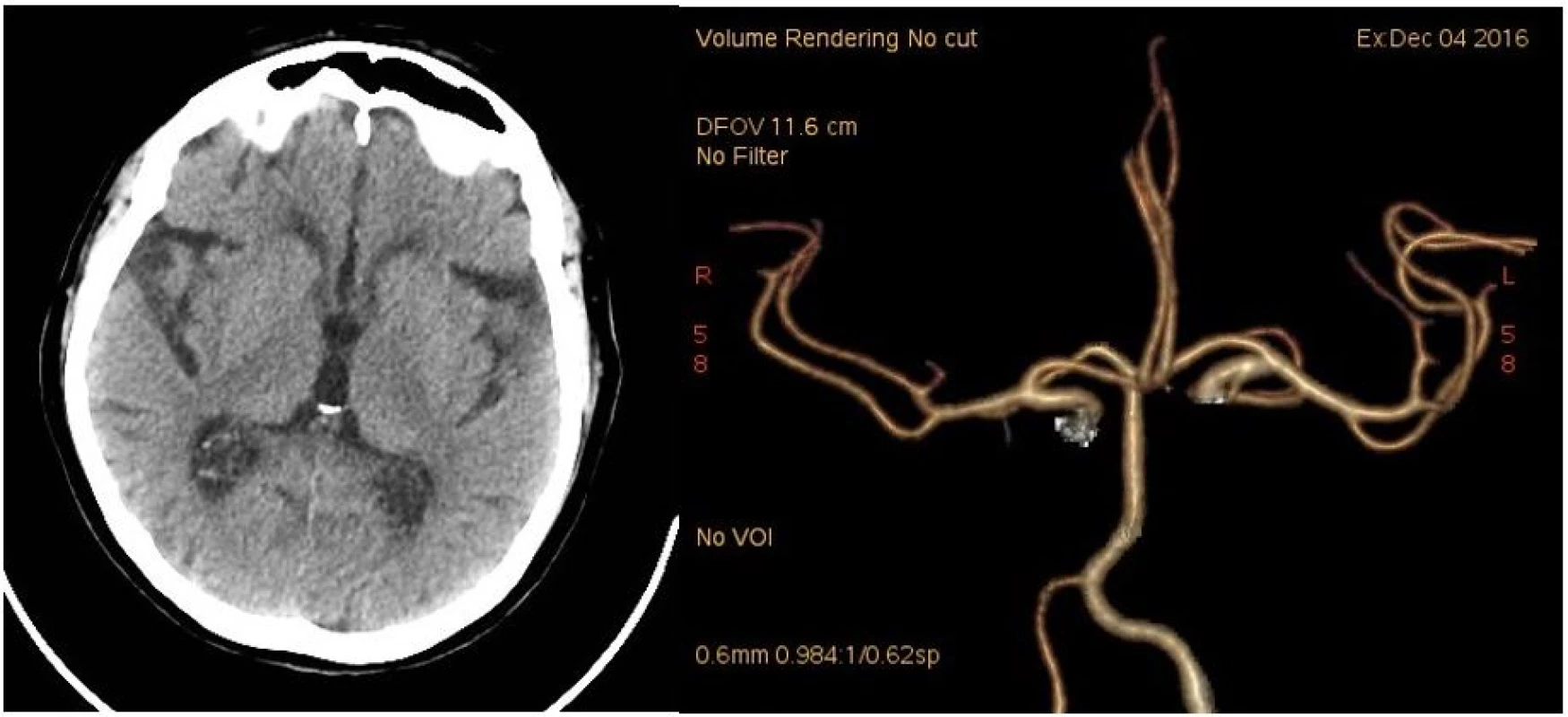 CT mozku při přijetí. 1A: nativ. 1B: CT angiografie (Volume Rendering Technique).