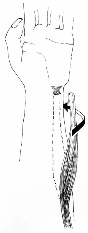 Nečastěji užívaný transfer ulnárního flexoru zápěstí (FCU) při spasticitě předloktí. 
