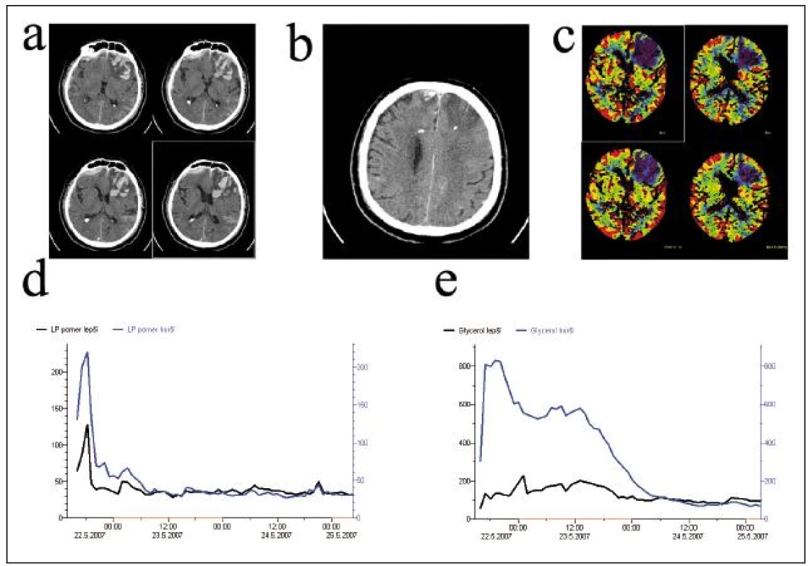 Bilaterální monitorace. Pacient s velkou kontuzí v levém frontálním laloku a drobným subdurálním hematomem a drobnou kontuzí v pravém frontálním laloku (a). Čidla mikrodialýzy a tkáňové oxymetrie byla implantována do obou frontálních laloků (b). Perfuzní CT mozku po implantaci ukazuje poruchu perfuze v oblasti kontuze (c). Hodnoty tkáňového metabolizmu byly v levé hemisféře (horší) byly zpočátku patologické a vyšší v porovnání s pravou (lepší) hemisférou. V průběhu další monitorace jsme díky minimalizaci sekundárních inzultů pozorovali stabilizaci hodnot tkáňového metabolizmu v levém, horším frontálním laloku. Zatímco hodnoty LP poměru v levé hemisféře se srovnaly s hodnotami v pravé hemisféře po 15 hod (d), hodnoty glycerolu se srovnaly s levou hemisférou až po 37 hod (e).
