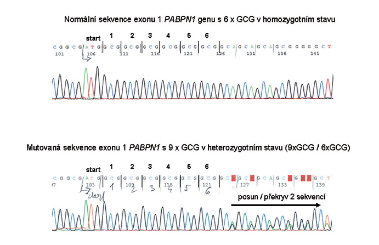 Příklady výsledků DNA vyšetření – nahoře s normálním počtem GCG tripletů, dole příklad mutace s alelou 9x GCG v PABPN1 genu v heterozygotním stavu.