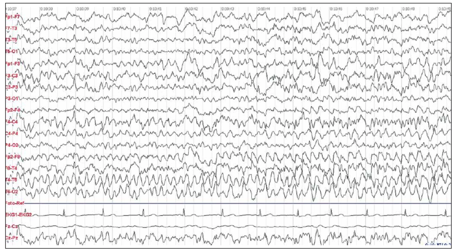 EEG nález u pacientky 1.
Fig. 1. Patient 1 EEG.