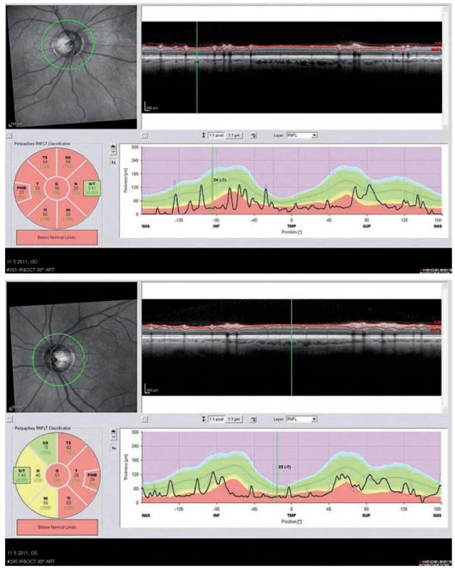 Optická koherentní tomografie (OCT) oka pravého a levého u 61letého pacienta po opakovaných optických neuritidách bil.
