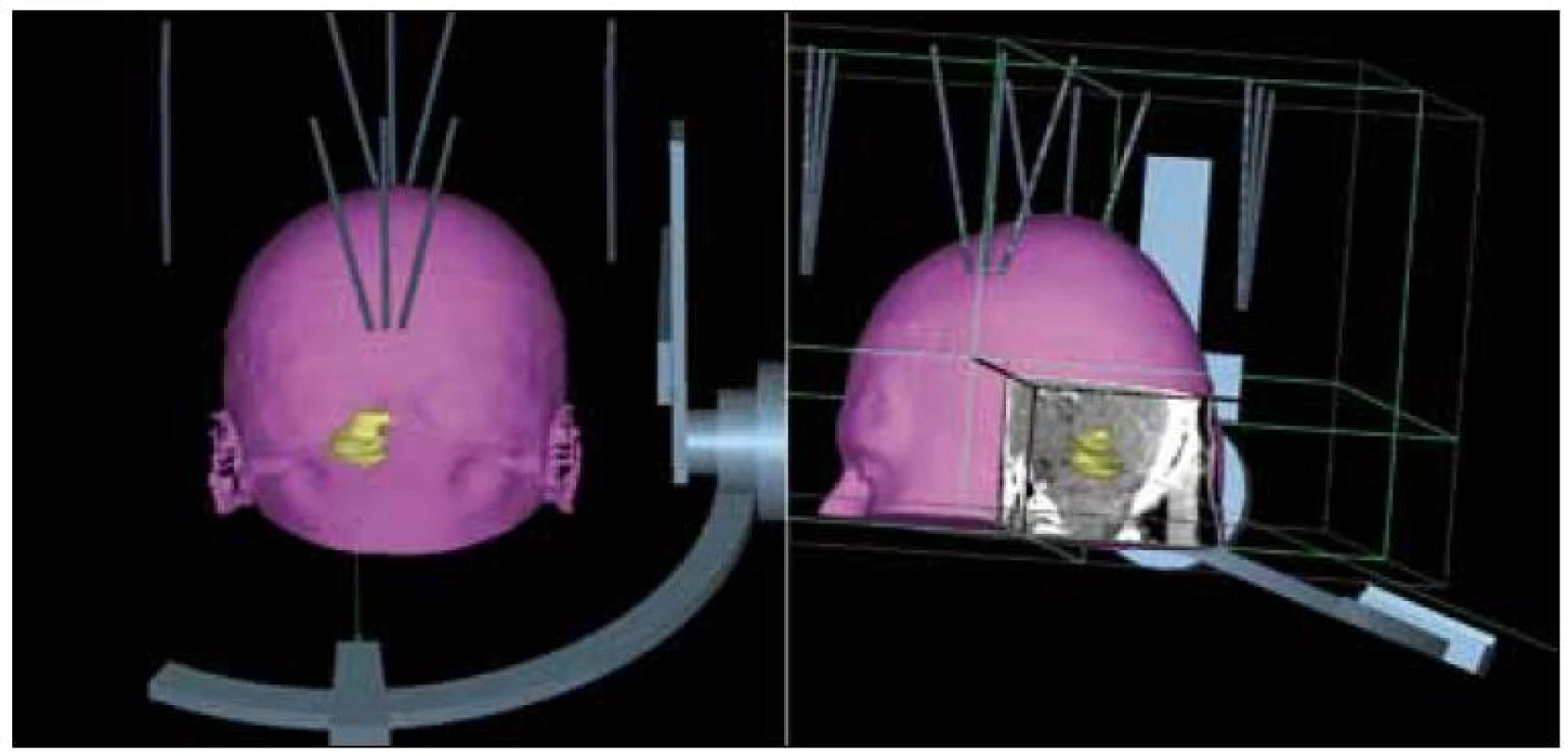 3D rekonstrukce transcerebellárního přístupu s obrácenou montáží stereotaktického rámu.