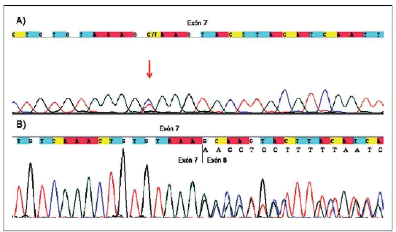 Netypická zostrihová mutácia v exóne 7 u pacienta P68.
Obr. 1a) gDNA sekvencia pacienta so substitúciou c.989C&gt;T (označená červenou šípkou), ktorá by na základe tejto sekvencie bola klasifikovaná len ako mutácia vedúca k zámene aminokyseliny p.Ala330Val v exóne 7.
Obr. 1b) cDNA sekvencia pacienta, ktorá ukazuje, že výsledným efektom vyššie uvedenej substitúcie je delécia časti exónu 7 (r.988_1062 del 75bp), ktorá na proteínovej úrovni vedie k delécii p.Ala330_Lys354del, a tým ku skráteniu NF1 proteínu.