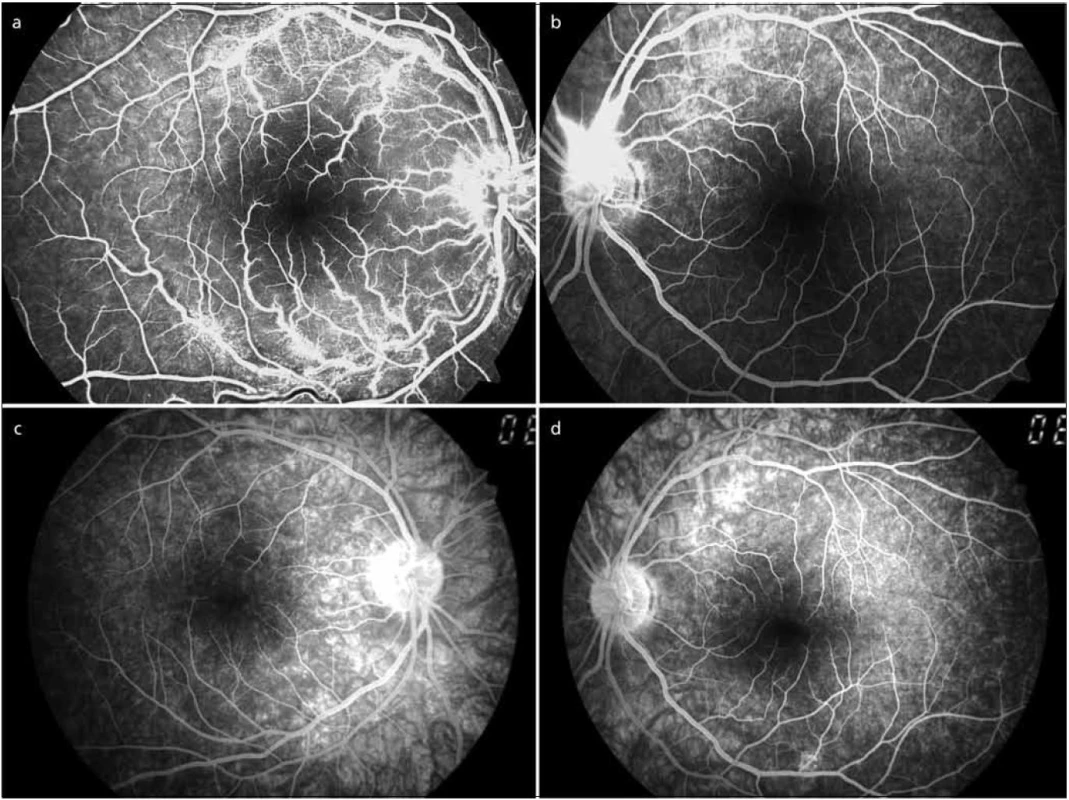 V horní polovině vstupní fluorescenční angiografie pravého a levého oka (2a, b), v dolní polovině kontrolní fluorescenční angiografie pravého a levého oka po dvou měsících (2c, d).