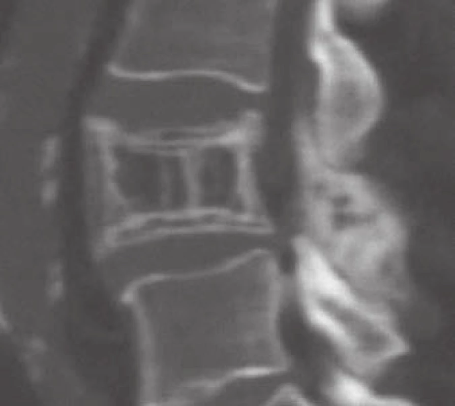 Typický CT příznak AHO v sagitálním řezu – „plástev medu“ („honeycomb“) anebo „manžestrový vzor“ („corduroy pattern“).