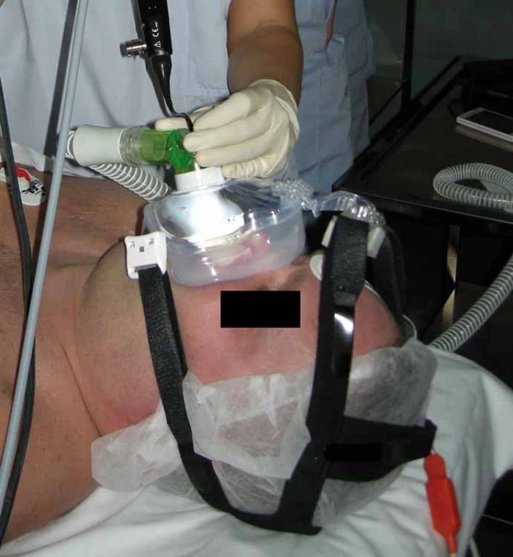 Spánková endoskopie s přetlakovou ventilací.
Fig. 1. Drug-induced sleep endoscopy with continuous positive airway pressure.