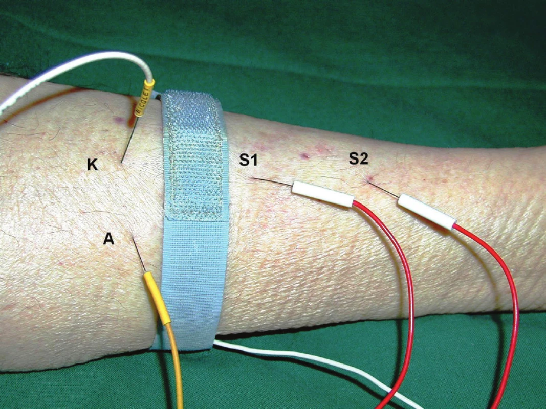 Umístění elektrod při vyšetření přímou svalovou stimulací – m. tibialis anterior. Monopolární stimulační jehlová elektroda zapojená jako katoda (K) je umístěna intramuskulárně do m. tibialis anterior distálně od motorického bodu svalu, druhá monopolární elektroda zapojená jako anoda (A) je umístěna subkutánně asi 2 cm laterálně od katody. Druhý pár monopolárních elektrod je použit ke snímání: S1 (zapojena jako aktivní) 2–3 cm distálně od katody intramuskulárně, S2 (referenční snímací elektroda) několik cm distálně od S1.