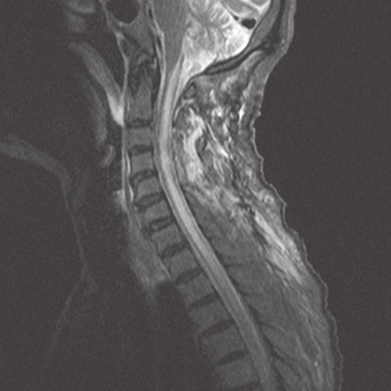 MRI krční páteře v sagitální rovině, ve STIR módu, dva dny po operaci, bez známek tumoru, se syringomyelickou dutinou.