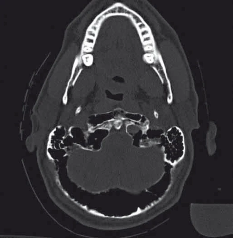 CT vyšetření v kostním okně s denzitami vzduchu v oblasti kostní dřeně okcipitální kosti, a  přední spony C1, se ztenčenou kortikalis.
 