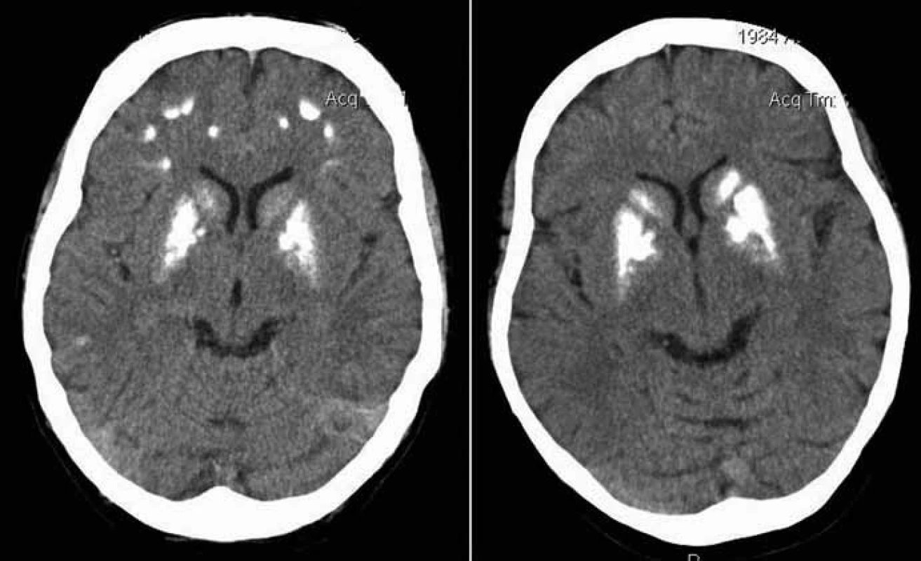 Nativní vyšetření CT mozku. Oboustranné kalcifikace v bazálních gangliích (nucleus caudatus, putamen) a talamu. Dále jsou patrné vícečetné kalcifikace v bílé hmotě frontálních a parietálních laloků.