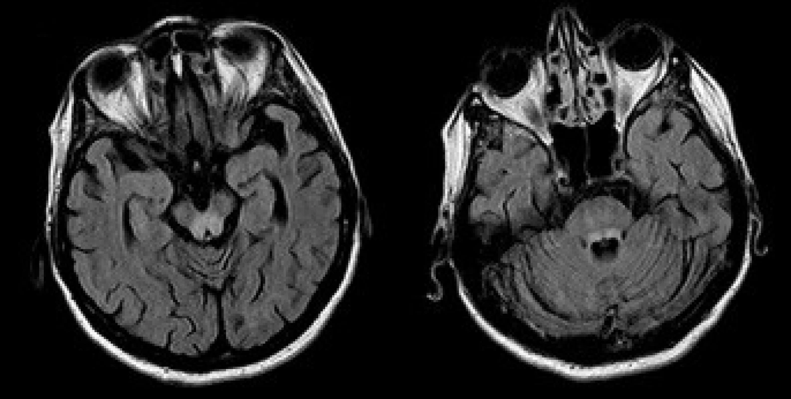 MRI mozku, transverzální vrstvy sekvence FLAIR. Patologické zóny T2 hyperintenzního signálu v oblasti colliculi inferiores (a) a horních mozečkových pedunkulů (b).