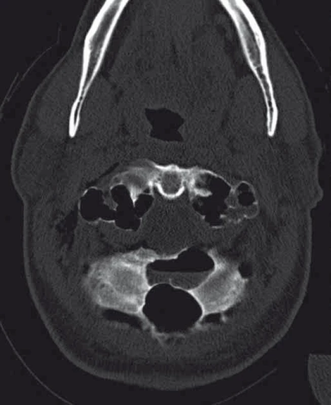 CT vyšetření s hladinkou tekutiny v atypicky pneumatizované části okcipitální kosti.