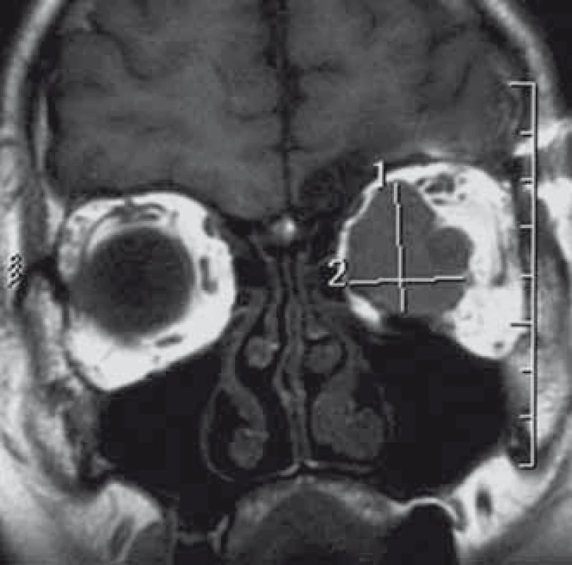 Exofytický meningeom pochvy optického nervu (typ dle Schickové Ic) v T2 váženém obraze MR.