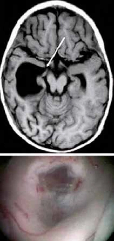 Temporální ventrikulostomie.
Na snímku z MR (obrázek nahoře) je znázorněno místo, kde byla provedena stomie(obrázek dole) [38].