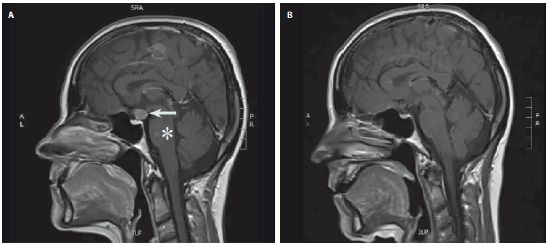 MR hypofýzy (T1 vážené sagitální skeny s kontrastní látkou). A – tumorózní expanze v oblasti infundibula lehce komprimující optické chiasma (šipka), v pontu postkontrastně se sytící okrsek odpovídající cévní malformaci typu kapilární teleangiektázie (hvězdička); B – stav po kompletním odstranění nádoru infundibula.
Fig. 1. MRI of the pituitary gland (T1-weighted sagittal scans with contrast). A – tumor of the infundibulum compressing optic chiasm (arrow). Capillary teleangiectasia of the pons with contrast enhancement (asterisk); B – condition after complete removal of the tumor.