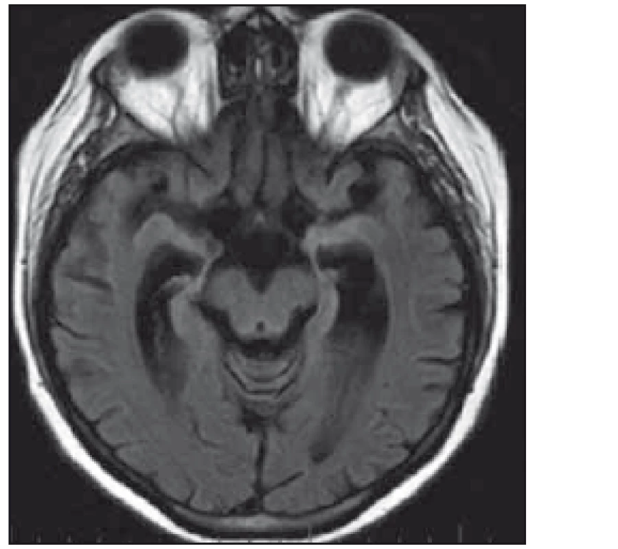 Pacientka 3 – na kontrolním MR mozku již rozvinutá atrofie limbického systému.
Fig. 3. Patient 3 – atrophy of limbic structures on the MRI.