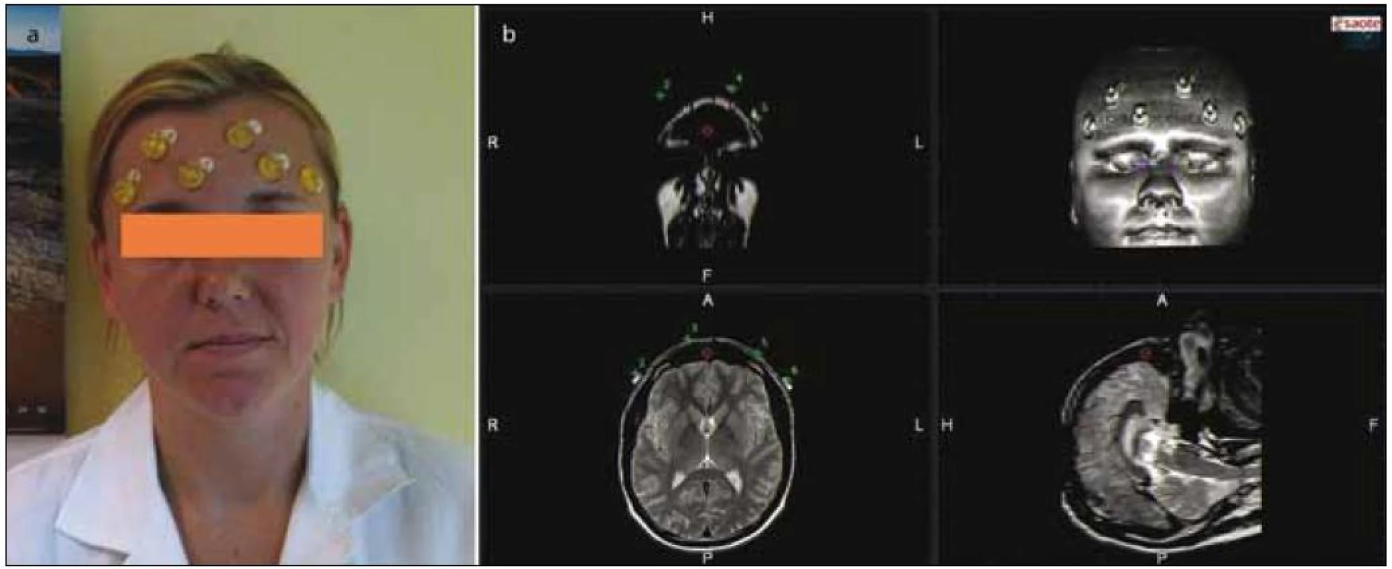 Umístění umělohmotných značek na obličeji vyšetřovaného subjektu (1a) a 3D rekonstrukce MR obrazu (1b).