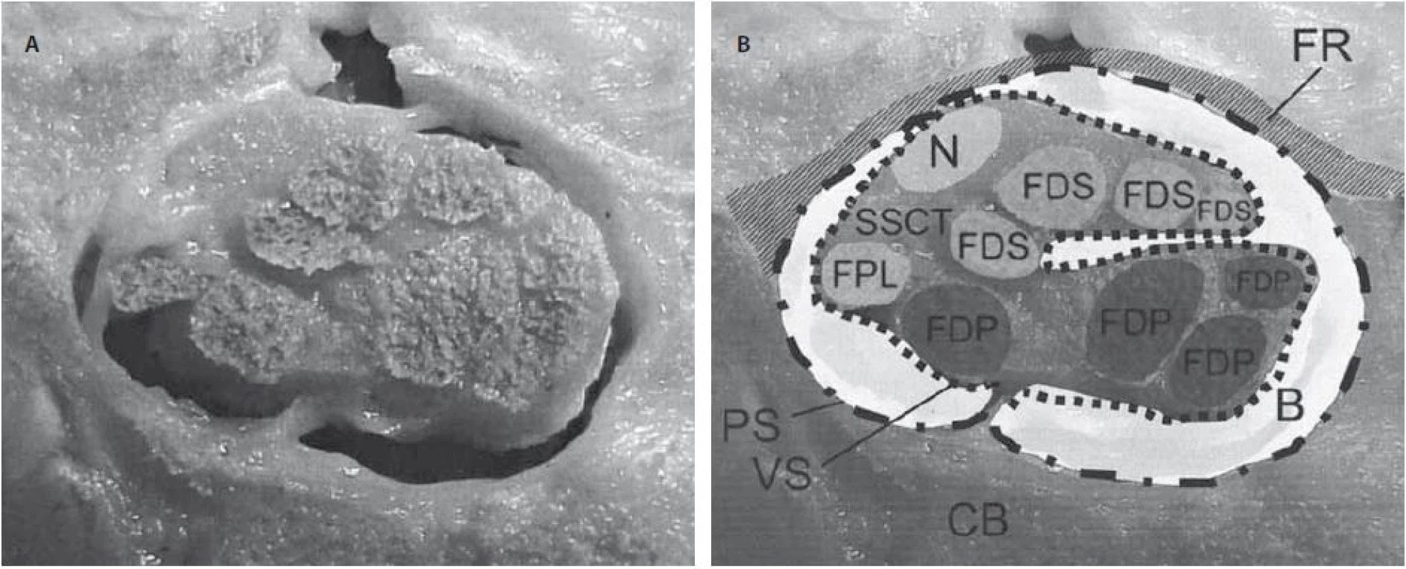Průřez karpálním tunelem u člověka v úrovni os hamatum (A). Schématický popis struktur uvnitř karpálního tunelu (B) [13].
Retinaculum flexorum (FR) a karpální kosti (CB) okolo karpálního tunelu a uvnitř karpálního tunelu nervus medianus (N), šlacha m. flexor pollicis longus (FPL), šlacha m. flexor digitorum profundus (FDP), šlacha m. flexor digitorum superficialis (FDS), bursa (B), parietální vrstva synoviální pochvy (PS), viscerální vrstva synoviální pochvy (VS).
Fig. 1. Transverse cut section through a human carpal tunnel at the hamate level (A). Schematic overview showing the structures within the carpal tunnel (B) [13].
The flexor retinaculum (FR) and carpal bones (CB) surrounding the carpal tunnel and within the carpal tunnel are the median nerve (N), flexor pollicis longus (FPL), flexor digitorum profundus (FDP) and flexor digitorum superficialis (FDS) tendons, bursa (B), subsynovial connective tissue – parietal synovial (PS) and visceral synovial (VS) layer.