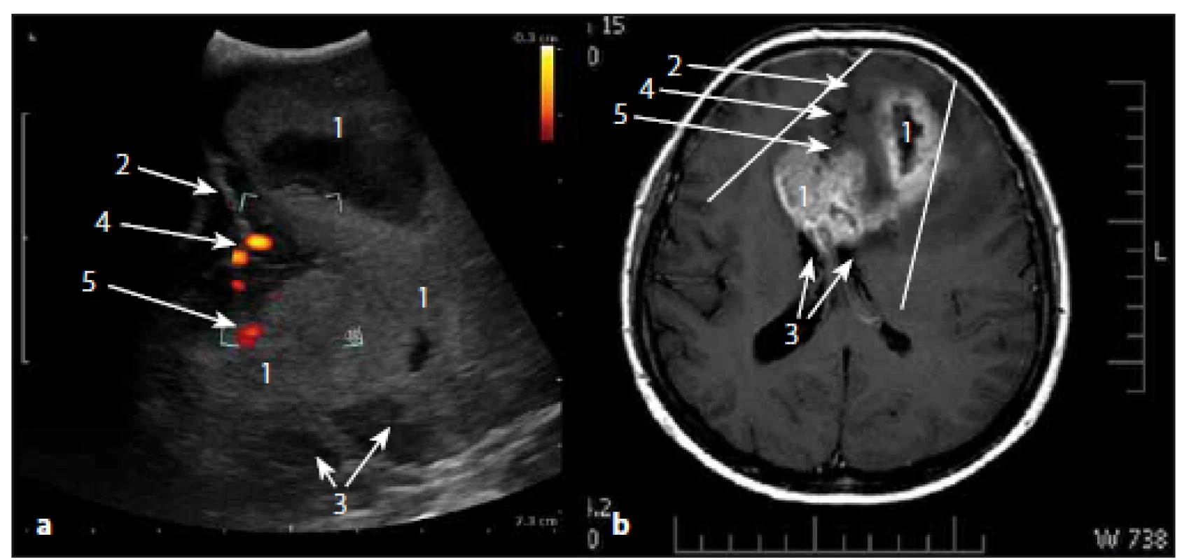 Glioblastom frontálně vlevo a v corpus callosum v sonografickém duplexním a MR T1W obraze.
Fig. 9. Glioblastoma of the left frontal lobe and of corpus callosum in ultrasound duplex image and MRI T1W image.