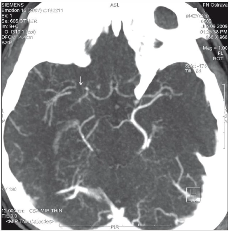 Stenóza kmene a. cerebri media (šipka) detekovaná pomocí CT angiografie.