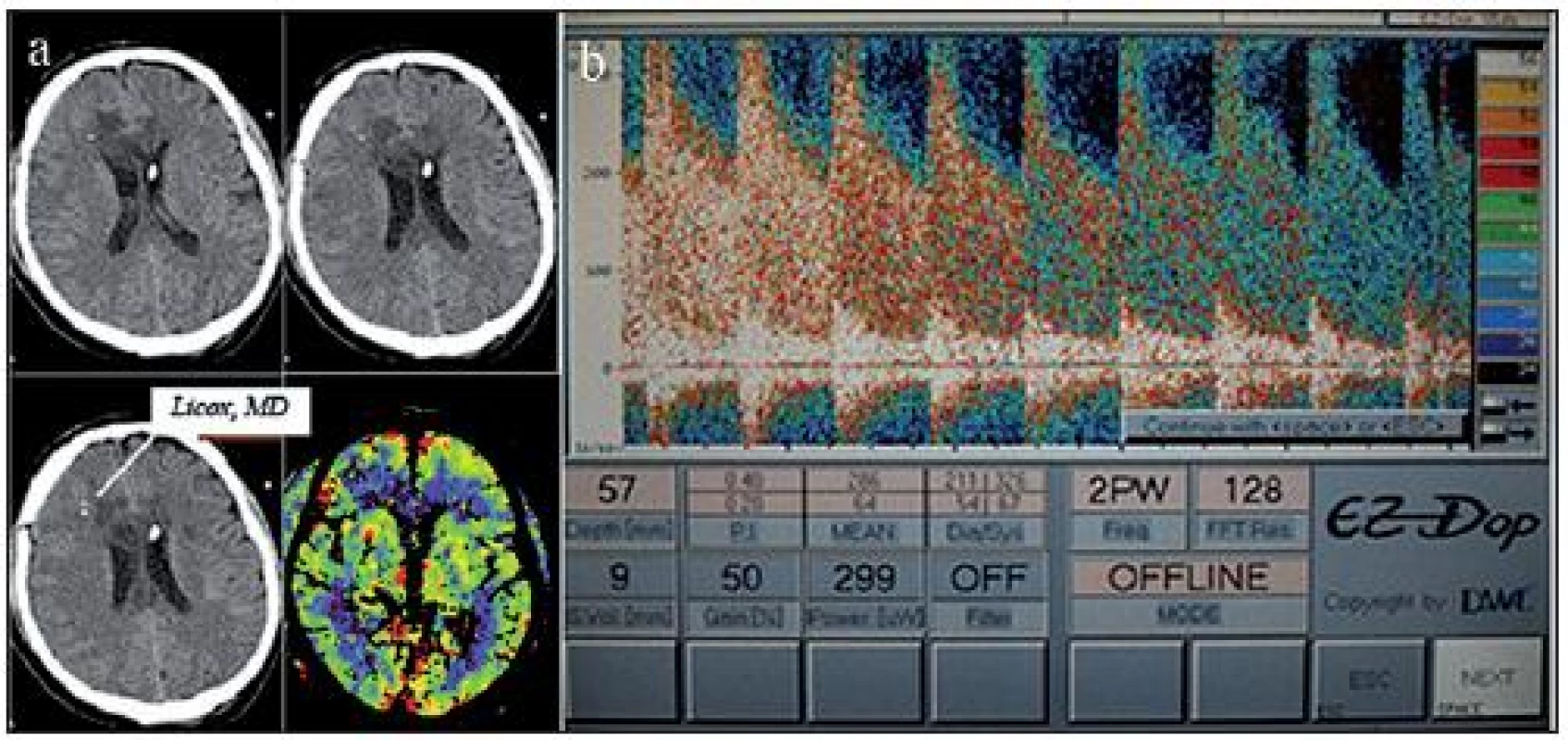 Nativní CT mozku po implantaci čidel monitorování tkáňové oxymetrie a metabolizmu a zevní komorové drenáže.
Patrné jsou ischemie v povodí ACA bilat. jak na nativním CT, tak i na perfuzním skenu v modalitě CBF (Cerebral Blood Flow; a). TCD po aplikaci bolusu nitroprusidu sodného ukazuje střední průtokovou rychlost v povodí ACM dx 286 cm/ s (b).