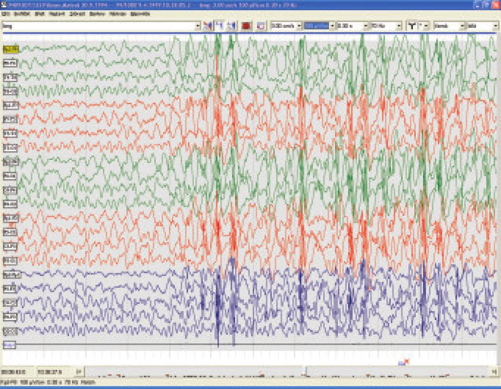 Bdělé EEG u 5letého chlapce s myoklonicko-astatickou epilepsií (Doose).
Nepravidelné polyspike-wave komplexy na nedokonalém pozadí EEG záznamu.