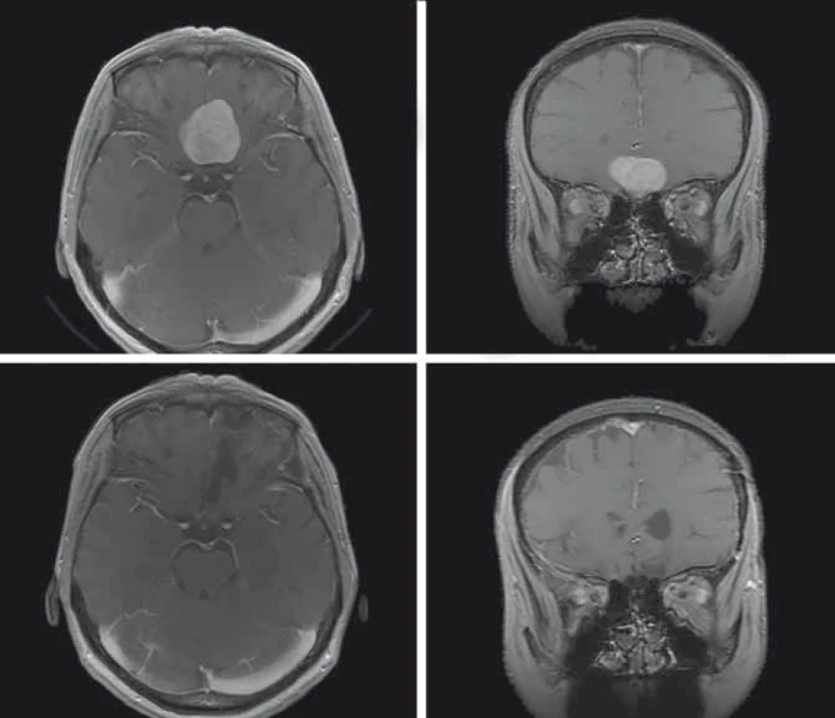 Předoperační MR, T1 vážené obrazy s kontrastní látkou, axiální a koronární řez (A, B). Pooperační MR, T1 vážené obrazy s kontrastní látkou, axiální a koronární řez, stav po radikální resekci, pooperačně pacientka bez neurologického defi citu, čich zachován (C, D).
Fig. 1. Preoperative MRI, T1-weighted images with contrast agent, axial and coronary plane (A, B). Postoperative MRI, T1-weighted images with contrast agent, axial and coronary plane, after radical resection, postoperatively patient without neurological defi cit, sense of smell is preserved (C, D).