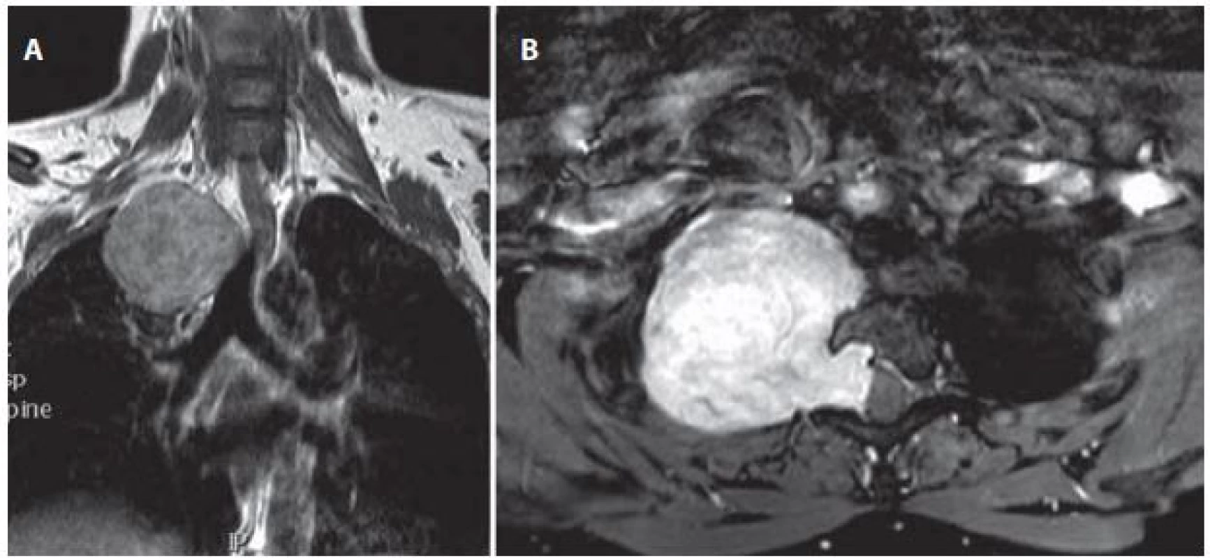 Žena (38 let) – sutkovitý nádor Th2–Th3 vpravo, před operací.
Obr. 6a) MR v koronální rovině.
Obr. 6b) MR v axiální rovině.
Fig. 6. Woman (38 years) – dumbbell-shaped right sided tumor at level Th2–Th3, before surgery.
Fig. 6a) Coronal view MRI.
Fig. 6b) Axial view MRI.