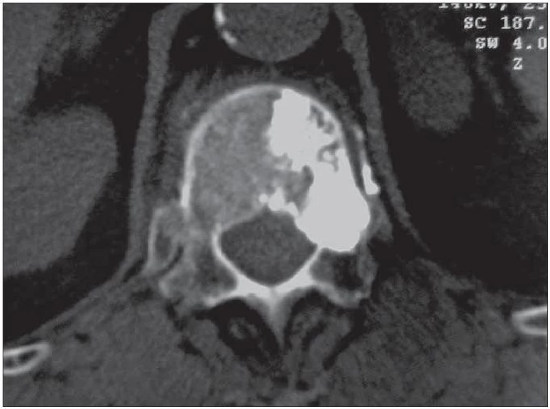 Juxtapedikulárně lokalizovanou osteolytickou metastázu do obratle Th12 (generalizovaný karcinomu prsu) jsme vyplnili kostním cementem.
PMMA z ložiska prosákl také ventrálně do spongiózy obratlového těla a pacientku bez známek lokální recidivy ambulantně sledujeme 4. rokem po výkonu.