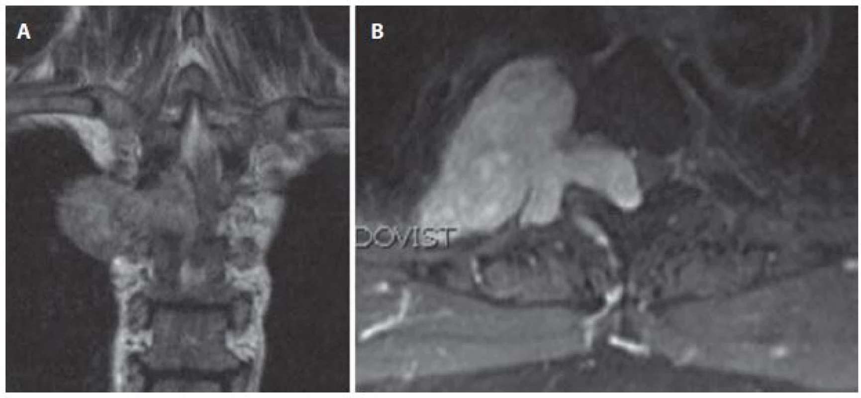 Muž (70 let) – sutkovitý nádor Th3–Th4 vpravo, před operací.
Obr. 5a) MR v koronální rovině.
Obr. 5b) MR v axiální rovině.
Fig. 5. Man (70 years) – dumbbell-shaped right sided tumor at level Th3–Th4, before surgery.
Fig. 5a) Coronal view MRI.
Fig. 5b) Axial view MRI.