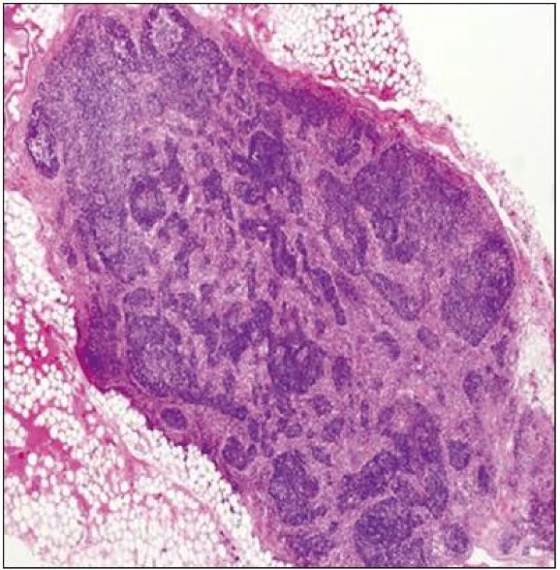 Tukovou tkání obklopená lumbální lymfatická uzlina se známkami atrofie, vazivově zesíleným pouzdrem s fibrotizací a histiocytózou splavů.