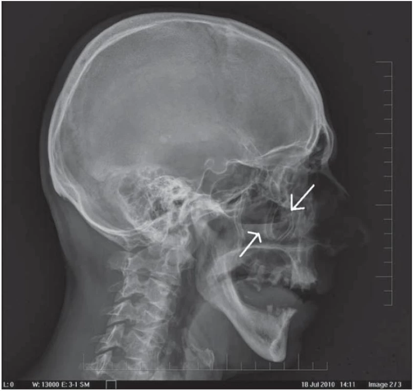 RTG lebky: 47-ročný pacient po úraze páčidlom do tváre pod pravé oko – pravá projekcia.