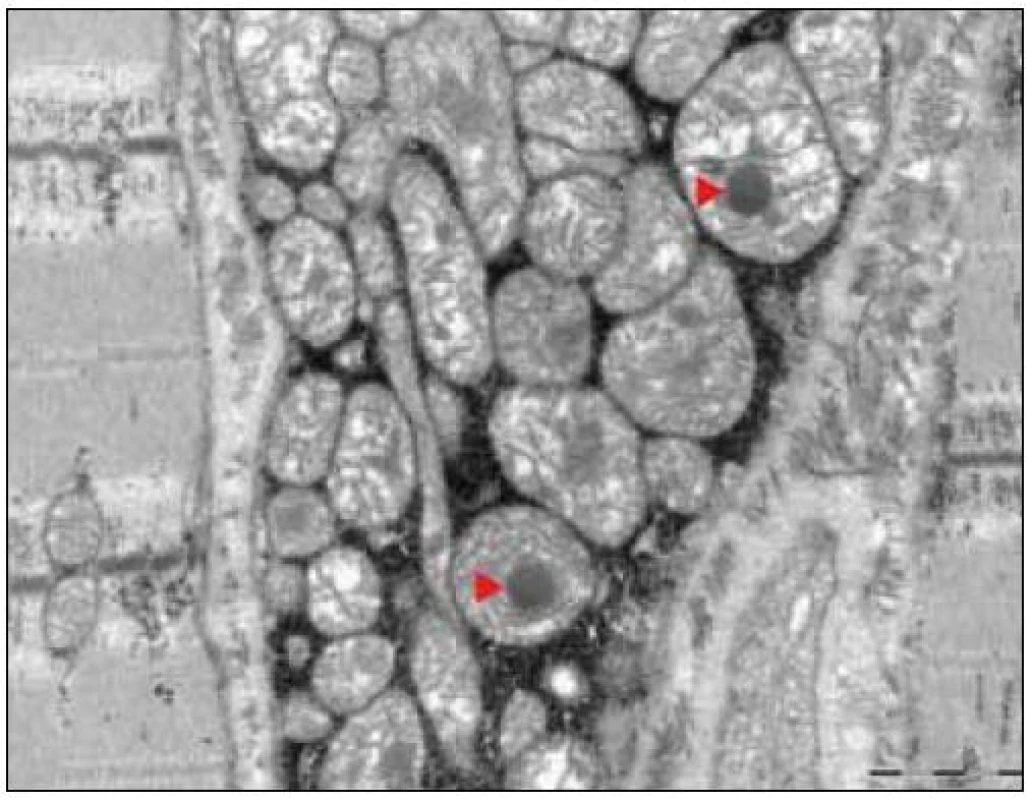 Agregát strukturálně abnormálních mitochondrií, intramitochondriální osmiofilní inkluze (►). EM.