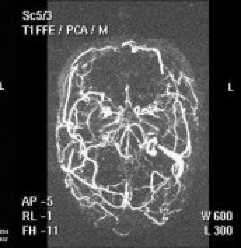 MRI vyšetření a MR venografie – (TOF) – subakutní fáze.
