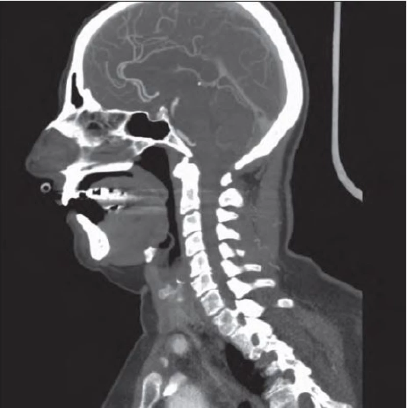 CT angiografie – multiplanární rekonstrukce zobrazující intrakraniální řečiště bez přítomnosti vzduchu.