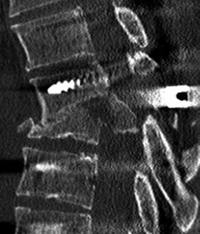 Ponechaná významná stenóza páteřního kanálu po stabilizaci páteře (CT sagitální rekonstrukce).