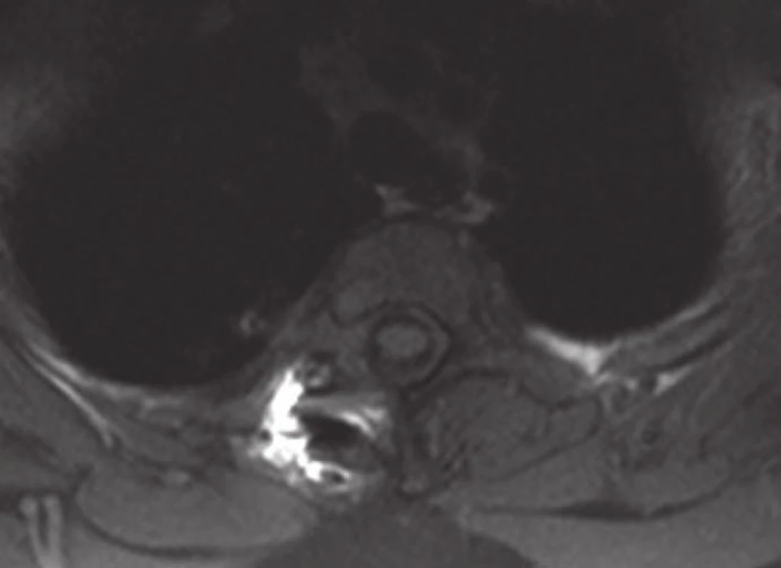 MR v axiální rovině, po operaci sutkovitého neurinomu Th2–Th3 vpravo (bez rezidua tumoru).
Fig. 7. Axial MRI, after surgery of a dumbbell-shaped righ-sided neurinoma at level Th2–Th3 right (without tumor residues).