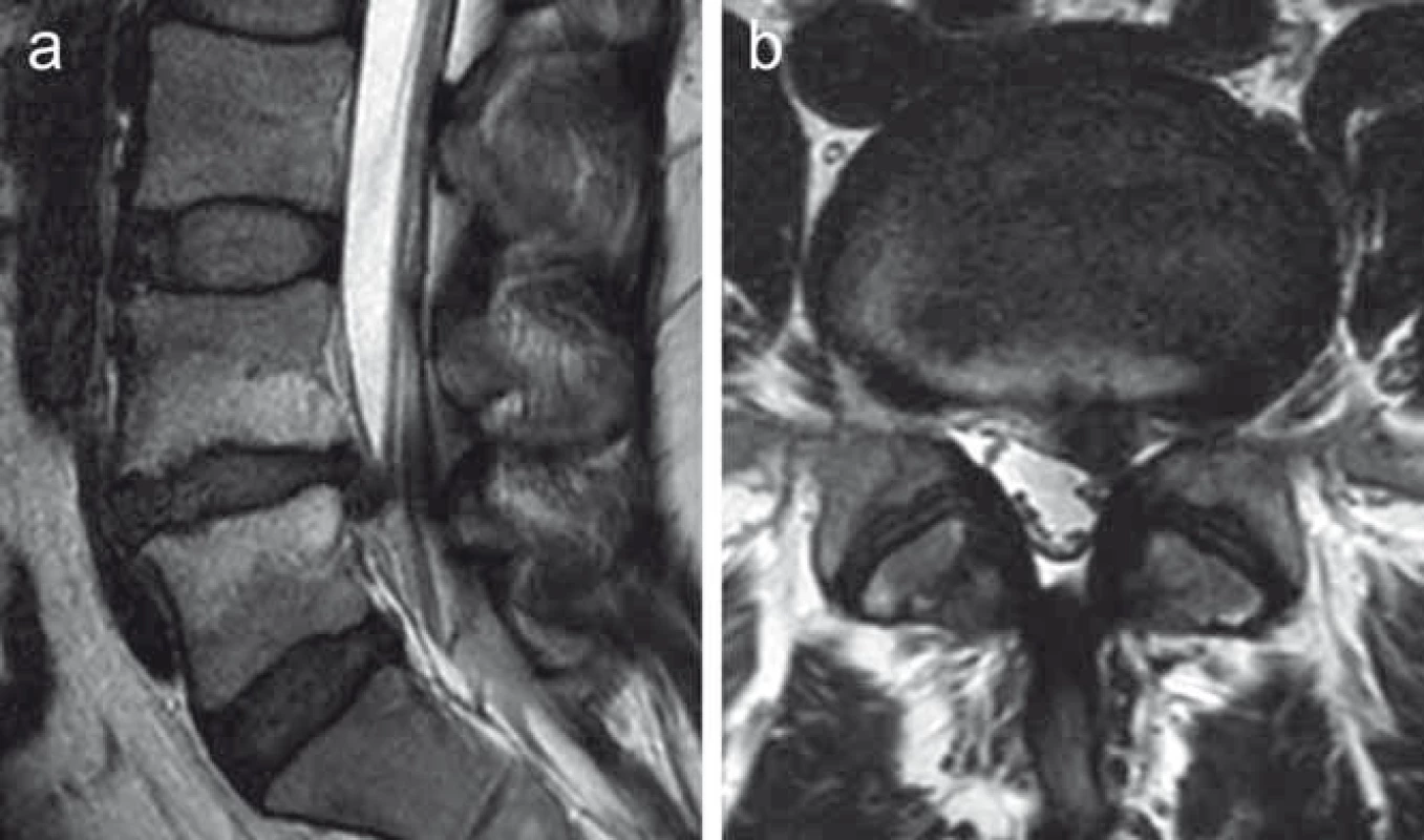MR vyšetření bederní páteře pacientky s levostrannou paramediální herniací ploténky L4–L5 zachycené v T2 váženém obraze v sagitální (a) a transverzální (b) rovině.
Útlak nervového kořene hodnocen dle Phirrmanna et al [38]. Hernie působí kompresi odstupujícího levostranného kořene L5, stupeň 3.
Fig. 3. MRI examination of the lumbar spine in a patient with left-sided paramedial disc extrusion at L4–L5 level depicted on T2-weighted MRI scans in sagittal (a) and axial (b) plane.
The compression of the nerve root is evaluated according to Phirrmann et al. [38]. The herniated disc significantly compresses the L5 nerve root; grade 3.