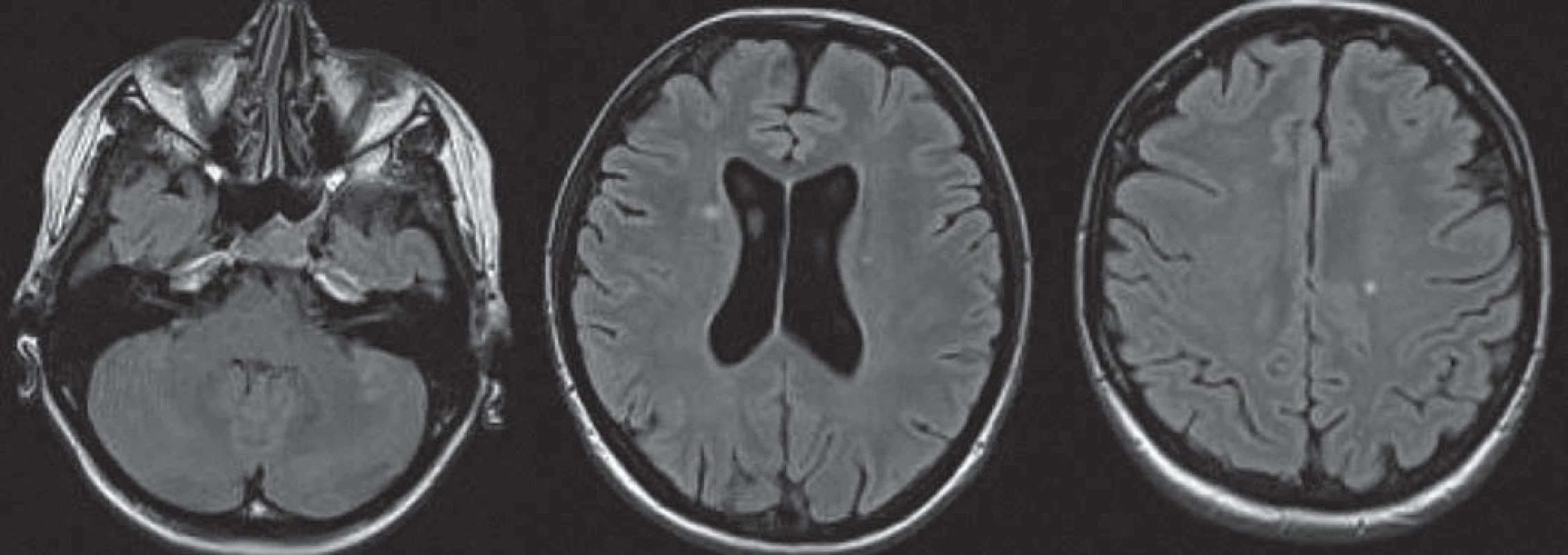Axiálne FLAIR – diseminácia v priestore: 25-ročný pacient s optickou neuritídou, prítomné štyri lézie v typických lokalitách: infratentoriálne vľavo, juxtakortikálne a periventrikulárne.