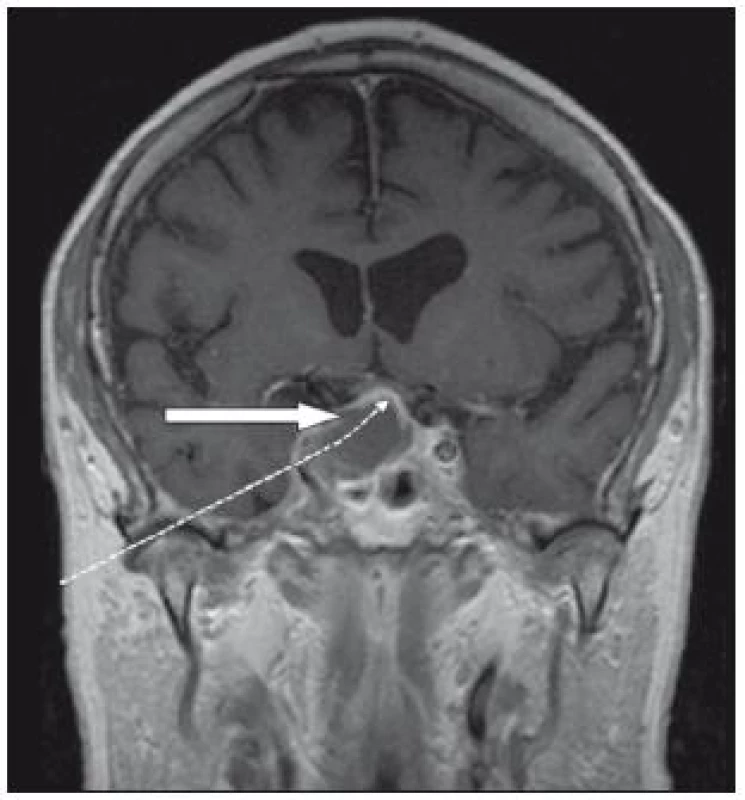 Magnetická rezonance.
T1 vážený obraz, koronární řez po kontrastu před operací. Plná šipka ukazuje na prokrvácený adenom, tečkovaná na zvednuté chiazma. Na pravé straně je patrno šíření do kavernózního sinu.