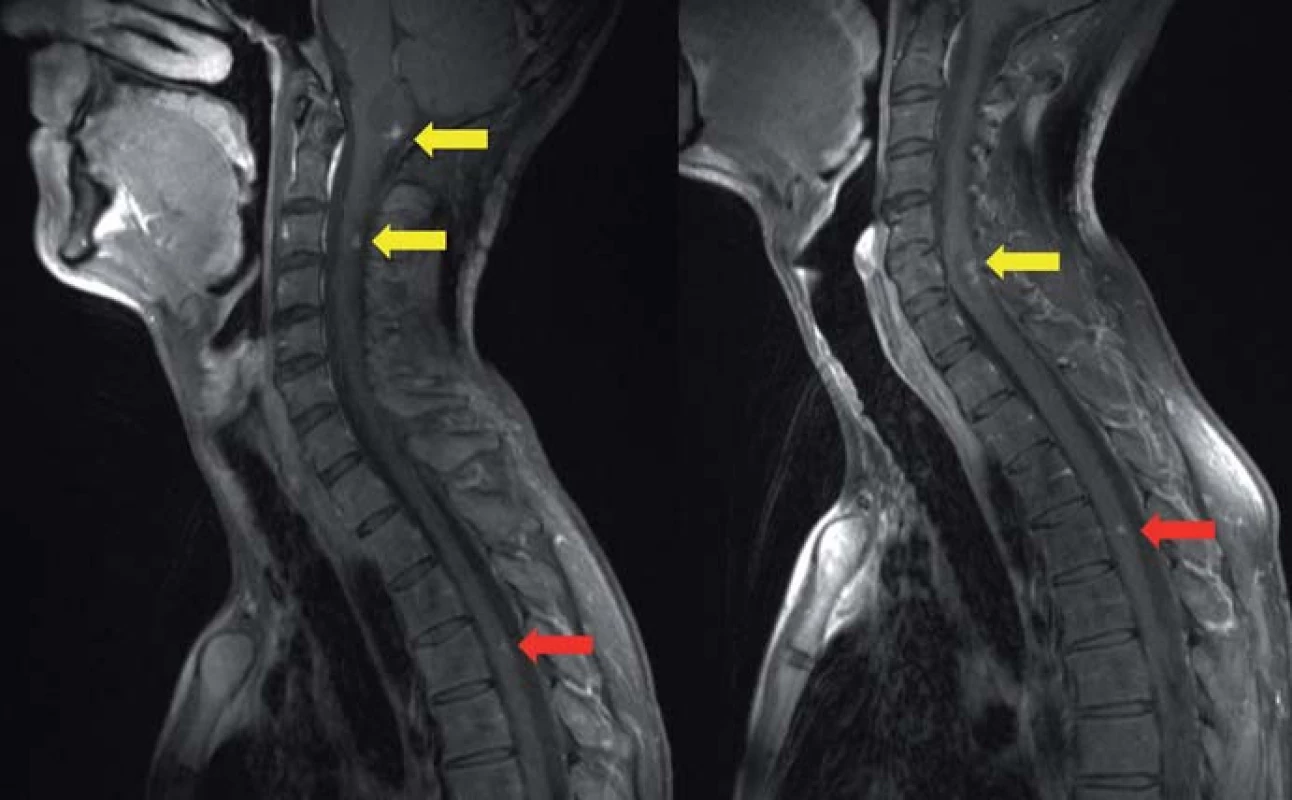 MR, T1 vážený obraz s kontrastem v sagitální rovině.
Mnohočetných hemangioblastomů mozkového kmene a míchy u 29letého muže; žluté šipky ukazují cystickou formu hemangioblastomu, červené šipky ukazují solidní formu hemangioblastomu