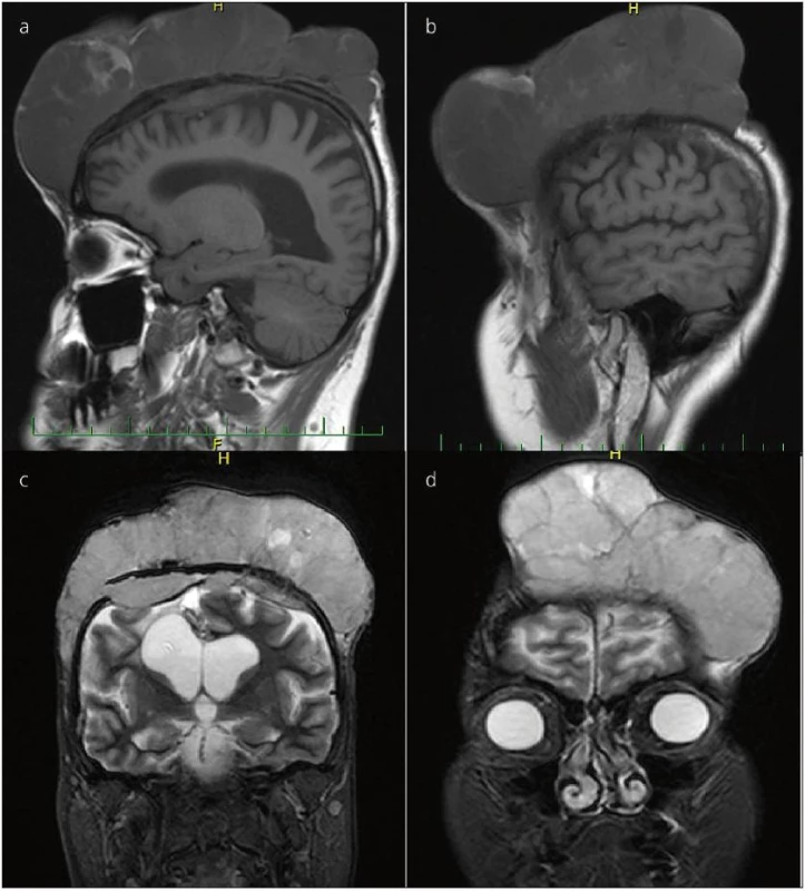 Gigantický recidivující meningeom s dominantní extrakraniální porcí, MR mozku před provedenou radikální exstirpací s kalvektomii.
Na dolním obrázku vlevo patrná i intrakraniální porce tumoru.