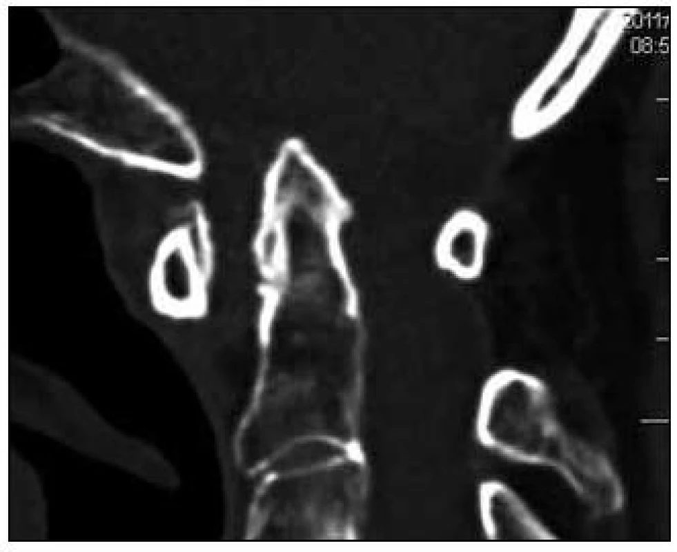 Kraniální migrace zubu čepovce na sagitální rekonstrukci CT vyšetření.