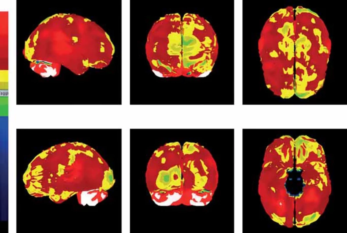 Trojrozměrné obrazy mozku s pohledy ze všech stran byly získány z vyšetření 99mTc-HMPAO SPECT mozku a ukazují sníženou perfuzi u vnuka pacientky s demencí. Změny perfuze jsou asymetrické, patrné je větší postižení vlevo s lehkou až hraniční redukcí difúzního charakteru.  Fig. 2. The three-dimensional images of the brain from all views were obtained from 99mTc-HMPAO regional brain perfusion scintigraphy (SPECT) of the brain and they show decreased perfusion of a grandson of a female patient with dementia. Perfusion changes are asymmetric, mostly located on the left side with slight to borderline diff use reduction.