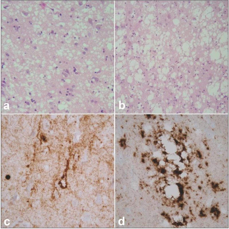Neuropatologický obraz prionového onemocnění.
Spongiformní dystrofie charakterizovaná malými (a) a většími, splývajícími (b) vakuolami, úbytkem neuronů a gliózou. Hematoxylin-eozin, zvětšení 400× (a), 200× (b). Imunohistochemické znázornění patologické formy prionového proteinu charakteru perineuronálních depozit na pozadí difuzní synaptické pozitivity (c). Perivakuolární a tzv. plaque-like depozita (d). Protilátka 6H4, zvětšení 400×.