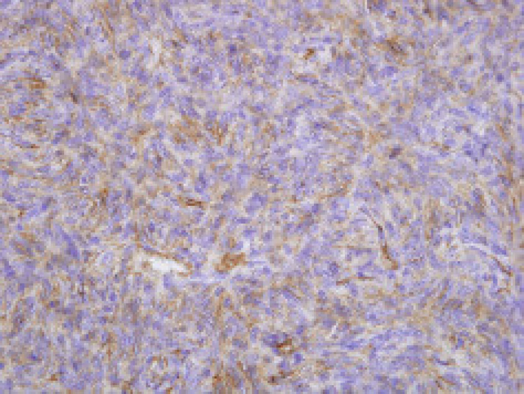 Solitární fibrózní tumor, imunohistochemický průkaz exprese CD 34v nádorových buňkách, 200×.