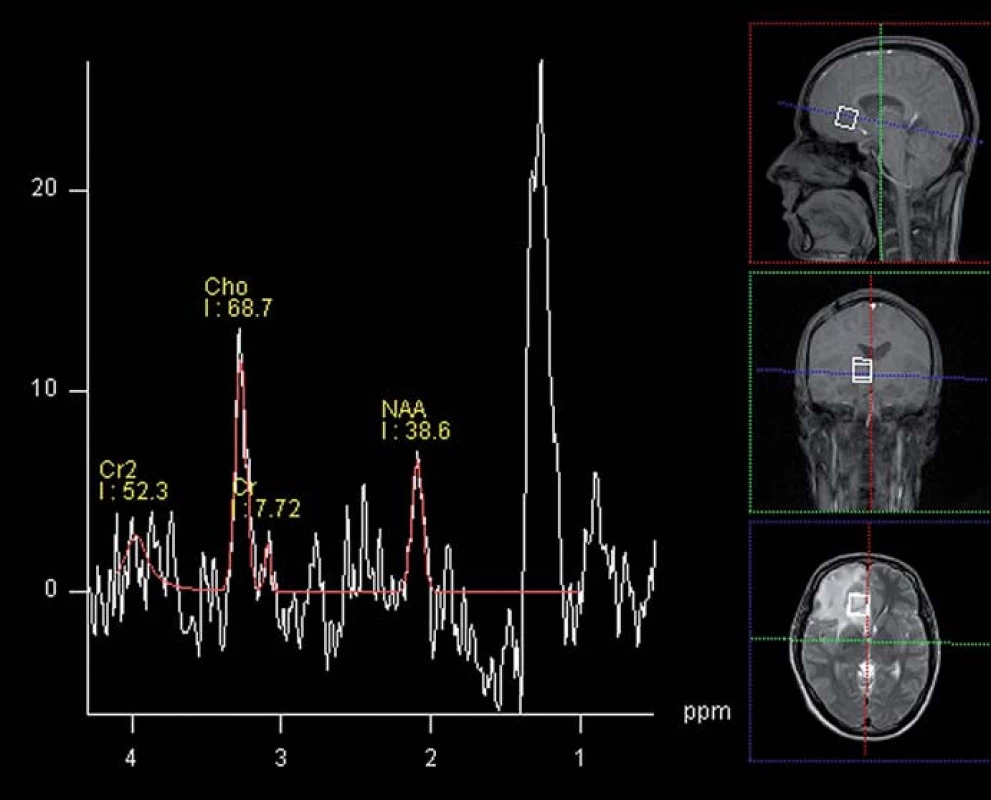 MR spektroskopie mozkového abscesu – patrná výrazná elevace laktátu v oblasti zájmu, nízká hladina NAA a lehce vyšší pík cholinu při zachycení i okolní mozkové tkáně (1,5T, SVS, TE 135 ms).
Fig. 3. MR spectroscopy of brain abscess – demonstrates signifi cant elevation of lactate in the area of interest, low levels of NAA and choline peak slightly higher when capturing surrounding brain tissue (1.5T, SVS, TE of 135 ms).