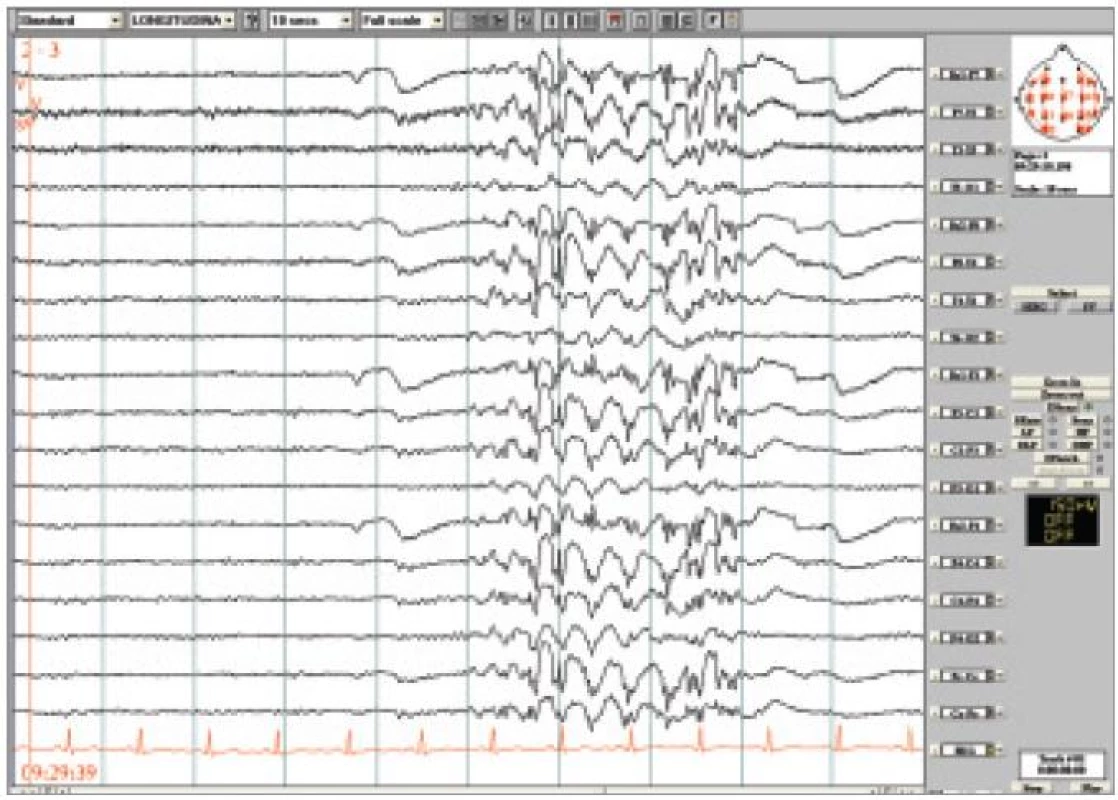 Kazuistika Jeavonsův syndrom. Po zavření očí generalizované výboje SW/PSW místy pravidelné, místy nepravidelné 3-5 Hz, v trvání většinou do 5 sekund. Longitudinální zapojení, LF 0,53 Hz, HF 70 Hz.